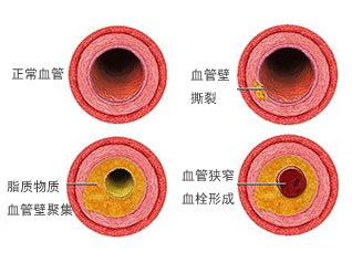 冠心病患者要养